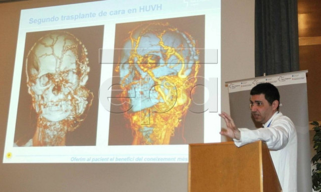 Άλλος ένας θρίαμβος της επιστήμης: Mεταμόσχευση προσώπου πέτυχαν Ισπανοί