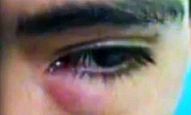 Οι γιατροί δεν μπορούσαν να φανταστούν τι έκρυβε στο μάτι του… για ένα μήνα (video&photos)