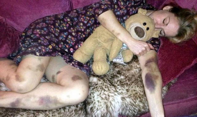 Σοκ: Ξύπνησε γεμάτη μώλωπες – Ήταν η αρχή του Γολγοθά της (pics)