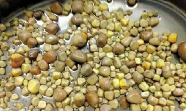 Του αφαίρεσαν 420 πέτρες από τα νεφρά