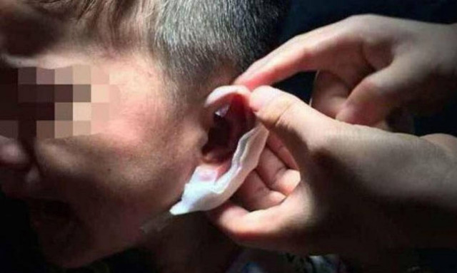 Δάσκαλος τρύπησε με... συρραπτικό τα αυτιά μαθητή