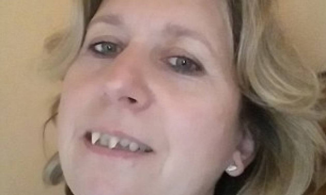 H γυναίκα που έβγαλε δόντια βαμπίρ (photos)