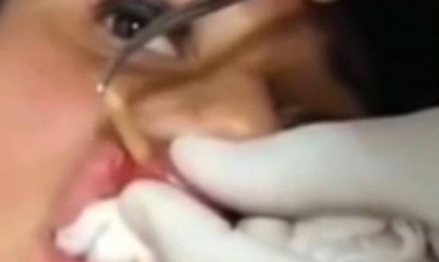 Βίντεο για γερά στομάχια: Αφαίρεσαν προνύμφη εντόμου από τα… χείλη της!