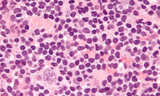 ΑγκαλιάΖΩ - Roche: Εκστρατεία ενημέρωσης για το λέμφωμα