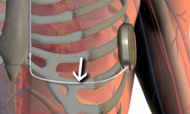 Ιατρικό Κέντρο Αθηνών: Η πρώτη εμφύτευση πλήρως υποδόριου απινιδωτή