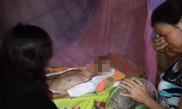 Βιετνάμ: Σαρκοφάγος ιός τρώει το πρόσωπό του εδώ και 11 χρόνια! (σκληρό βίντεο)