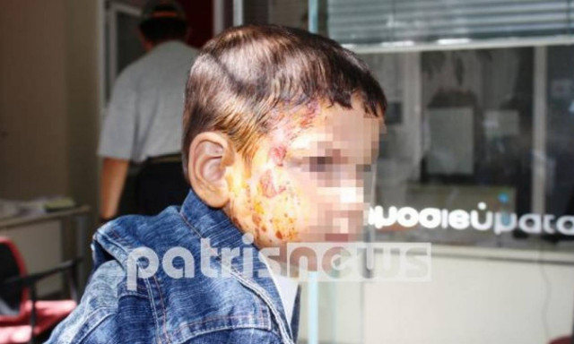 Καταγγελία - σοκ στον Πύργο: Εργοδότης έλουσε με καυτό καφέ αγοράκι 2 ετών