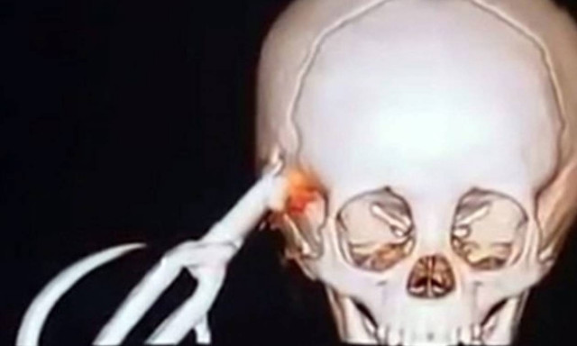 Νήπιο κάρφωσε ψαλίδι στο κεφάλι του καθώς οι γονείς του ετοίμαζαν το φαγητό