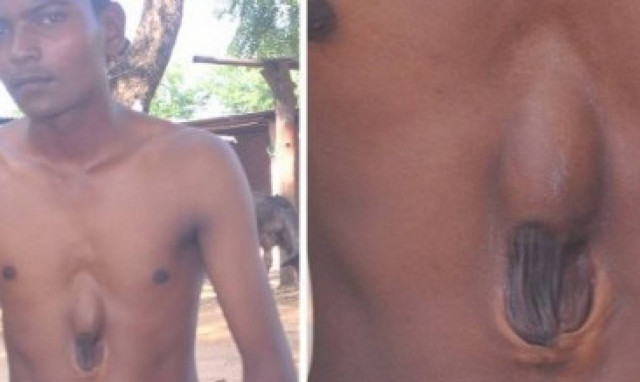 Ιατρικό θαύμα: Ο άνθρωπος που ζει με την καρδιά έξω από το στήθος! (video)