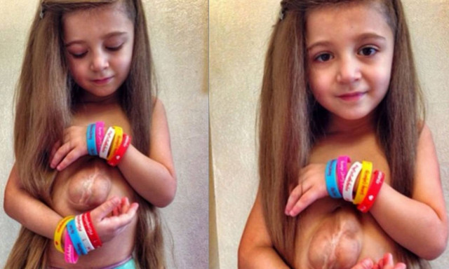 Η συγκλονιστική ιστορία πανέμορφης «πριγκίπισσας» που γεννήθηκε με την καρδιά έξω από το σώμα (vids)