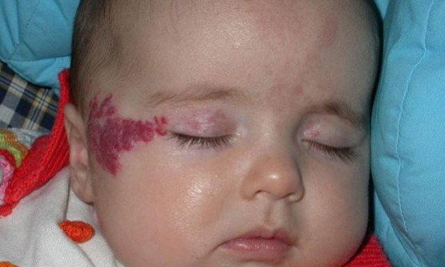 Πότε εμφανίζονται τα αιμαγγειώματα στα παιδιά και πώς θεραπεύονται;