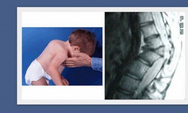 Νόσος Scheuermann: Τι είναι και πότε εμφανίζεται στα παιδιά