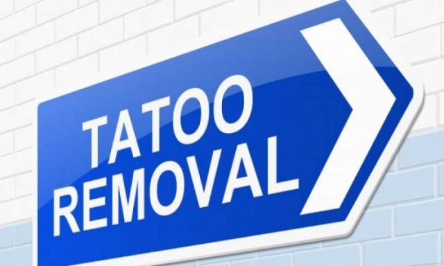 Αφαίρεση τατουάζ: Πώς γίνεται; Πόσο αποτελεσματική είναι;