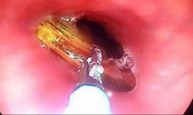 Απίστευτο: Της στάθηκε το χάπι και κατάπιε χτένα για να το διώξει (pics)