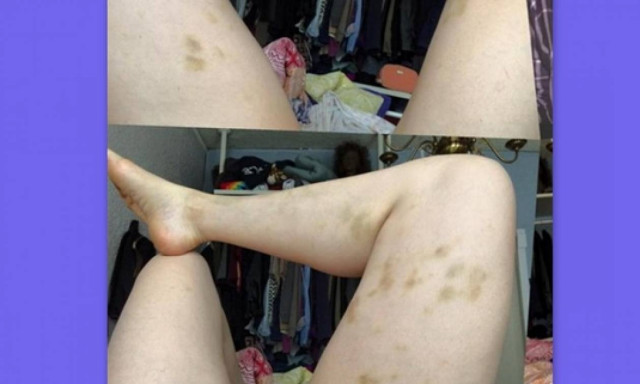 Σοκαριστική φωτογραφία: Ηθοποιός δεχόταν σωματική βία από τον σύντροφό της