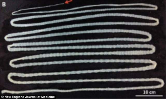 Κίνα: Σκουλήκι έξι μέτρων αναπτυσσόταν στο στομάχι ενός άνδρα