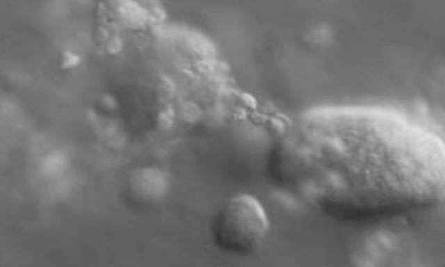 Δείτε για πρώτη φορά πώς τα καρκινικά κύτταρα «χτυπούν» τα υγιή δημιουργώντας όγκους (video)