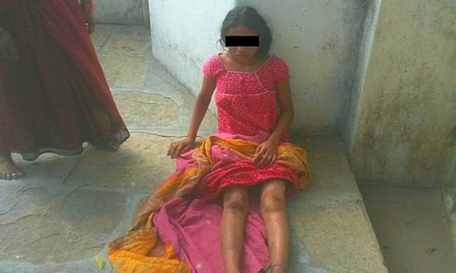 Κτηνωδία! Έκαψαν τα γεννητικά όργανα εγκύου για να την εκδικηθούν