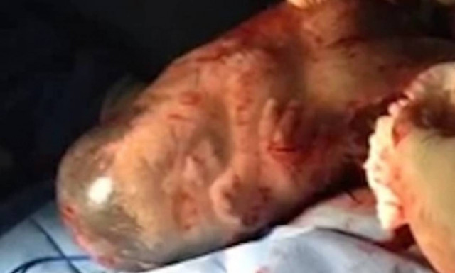 Η συγκλονιστική στιγμή που νεογέννητο παίρνει την πρώτη του ανάσα (video)