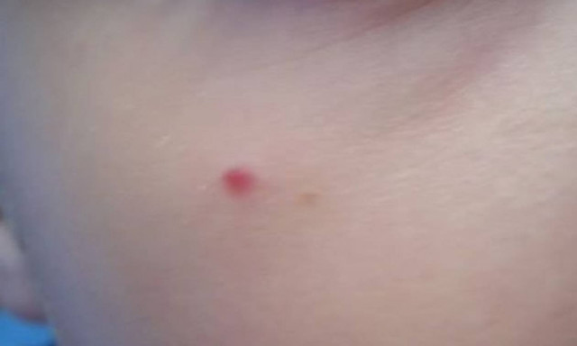 Δεν πείραξε το σπυράκι του για 20 χρόνια – Αυτό που έβγαλε θα σας ανατριχιάσει (video)