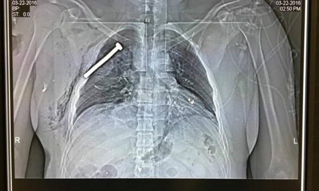 Βρυξέλλες: Βίδες, καρφιά και μεταλλικά αντικείμενα στα σώματα των θυμάτων (ανατριχιαστικές εικόνες)