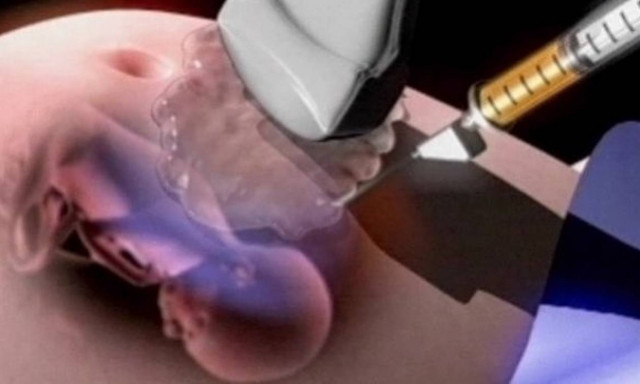 Αμνιοπαρακέντηση: Τι είναι, πότε γίνεται και ποιους κινδύνους κρύβει!