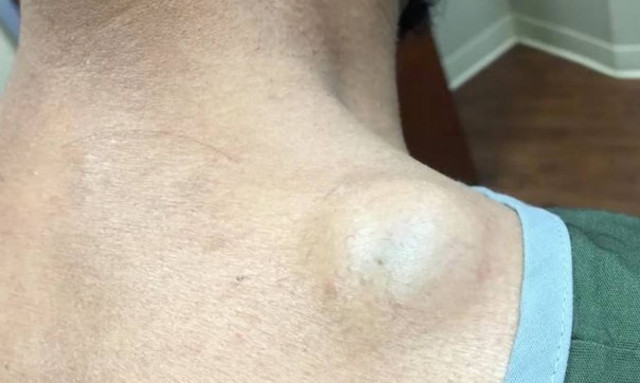 Το άφηνε να μεγαλώνει στον ώμο του για 15 χρόνια – Αντέχετε να δείτε τι; (video)