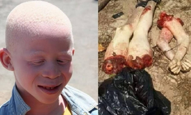 Κυνηγώντας… ανθρώπους στο Μαλάουι: Κύμα επιθέσεων χωρίς προηγούμενο σε αλμπίνους