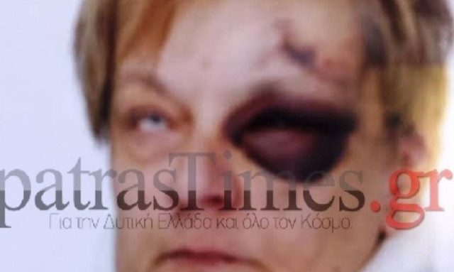 Φωτογραφία σοκ: Πήγε να του ζητήσει τα ενοίκια και την έκανε μαύρη στο ξύλο