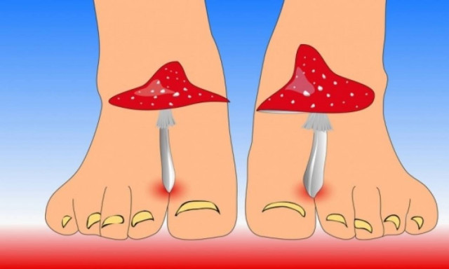 Μύκητες στα πόδια: Τι να προσέξετε για να τους αποφύγετε
