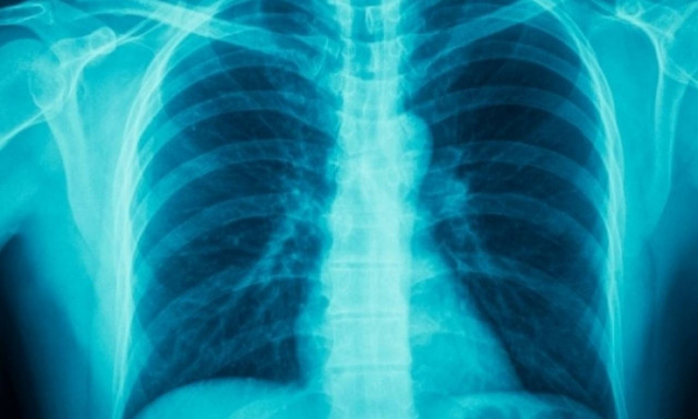 ΧΑΠ: 3η αιτία θανάτου παγκοσμίως – 600.000 οι Έλληνες πάσχοντες