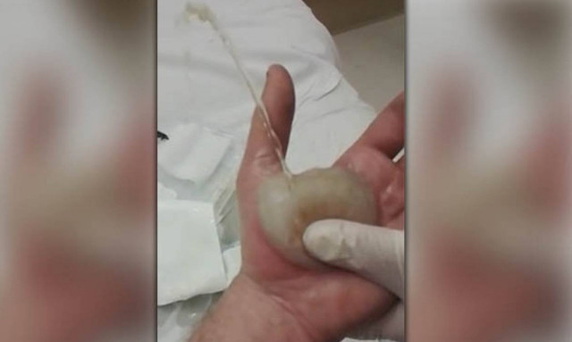 Ελάχιστοι κατάφεραν να το δουν ολόκληρο: Τεράστια φουσκάλα σκάει στο χέρι του και… (video)