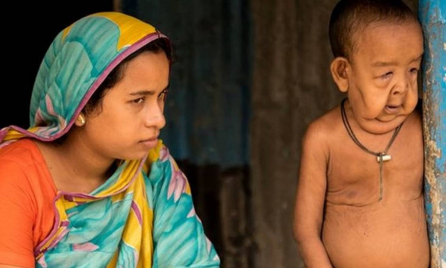 Αυτός είναι ο πραγματικός «Μπέντζαμιν Μπάτον»: 4χρονος ζει σε σώμα 80χρονου! (video+photos)