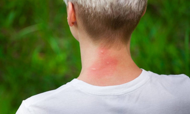 Σας τσίμπησε κουνούπι; Έτσι θα ανακουφιστείτε από τη φαγούρα