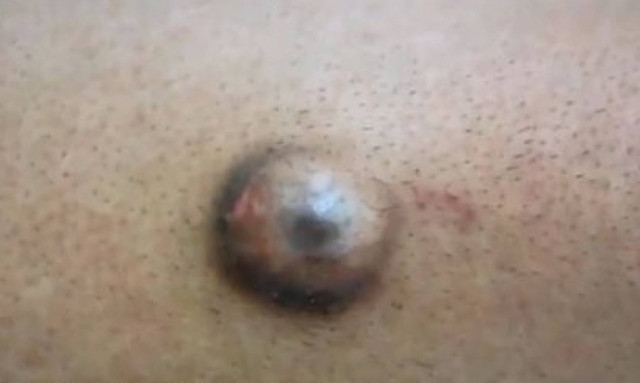 Δεν έχετε ξαναδεί κάτι τέτοιο! Μοιάζει με μάτι και μεγαλώνει μέσα στο πόδι του. Tι είναι; (video)