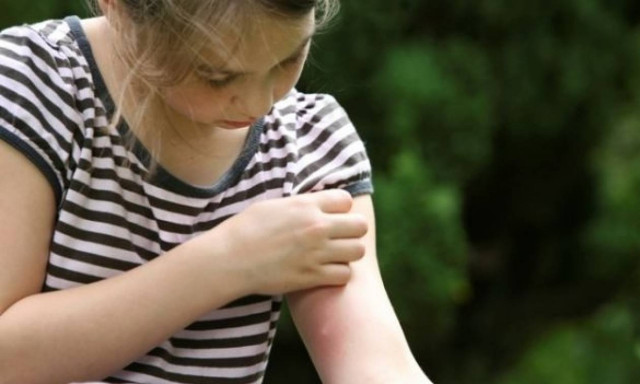 Τσιμπήματα: Απλές οδηγίες για τον «πονοκέφαλο» του καλοκαιριού