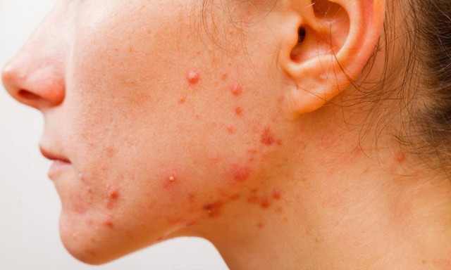 Ακμή: Οι 4 κανόνες πρόληψης που σε σώσουν