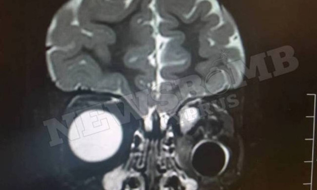 Έμοιαζε με κάτι εξωγήινο - Δείτε τι έχει αυτό το κοριτσάκι στη θέση του ματιού (photos)