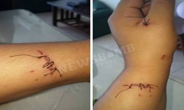 Καταγγελία - σοκ: Απέλυσαν Κύπρια επειδή έκοψε τα χέρια της και πήρε πενθήμερη άδεια (photos)