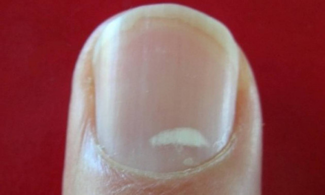 Τι είναι τα λευκά σημάδια στα νύχια μας
