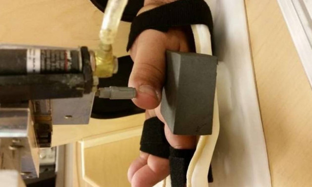 Ακρωτηριασμένοι απέκτησαν ξανά αίσθηση αφής μέσα από το τεχνητό χέρι τους (video)