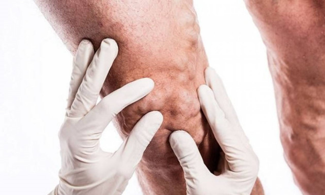 Κι αν αγνοήσω τους κιρσούς;