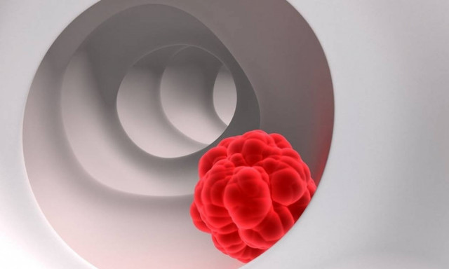 Κολονοσκόπηση: Πότε δεν εντοπίζει τον ορθοκολικό καρκίνο