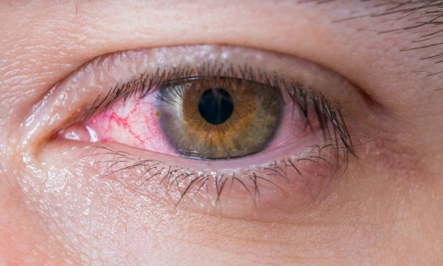Κοκκίνισμα ματιών: Ποιες είναι οι πιθανές αιτίες