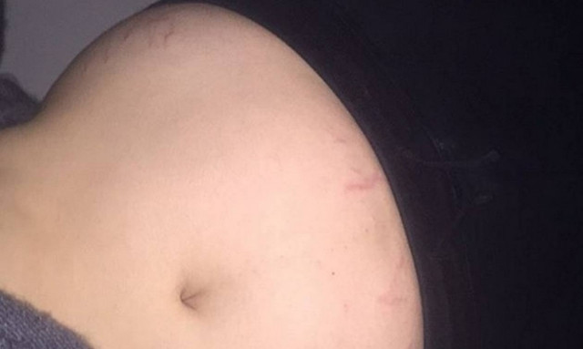 Κι όμως μοντέλο τολμά και δείχνει τις ραγάδες, που έχει στο κορμί της