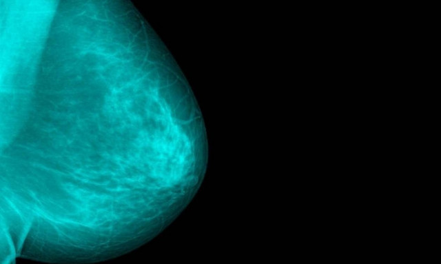 Καρκίνος μαστού: Τέσσερα ανησυχητικά σημάδια εκτός από τους ψηλαφητούς όγκους