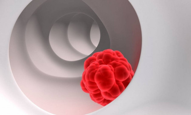 Καρκίνος παχέος εντέρου: Τα συμπτώματα και ποιοι κινδυνεύουν περισσότερο