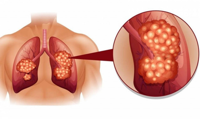 Καρκίνος του πνεύμονα: 8 σημάδια που πρέπει να γνωρίζετε