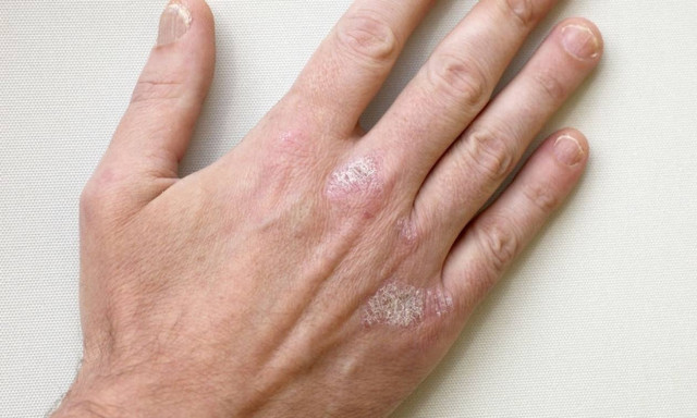 Ψωρίαση: Τι πρέπει να κάνετε για να περιορίσετε τα συμπτώματα
