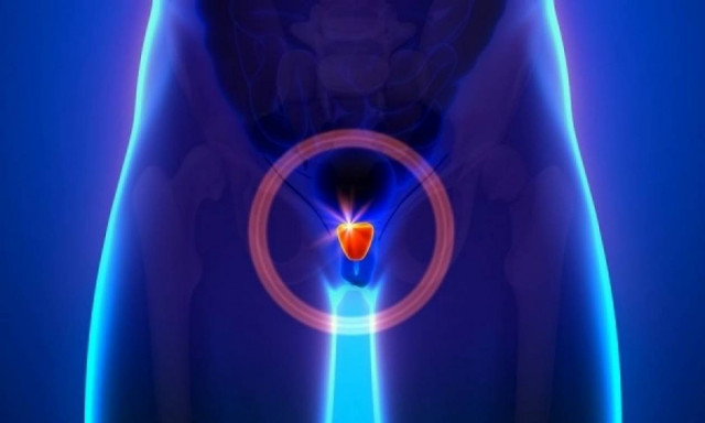 Υπερπλασία προστάτη: Ποια είναι τα συμπτώματα, πώς αντιμετωπίζεται